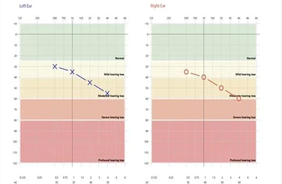 Hearing Assessments & Severity Levels